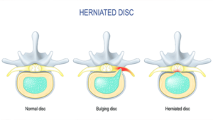 Herniated Disc. How To Value Your Head And Neck Injury.